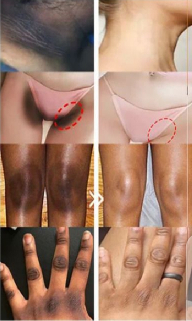 whitening-cream-for-sensitive-areas-underarm-and-private-areas---30g_PD4797
