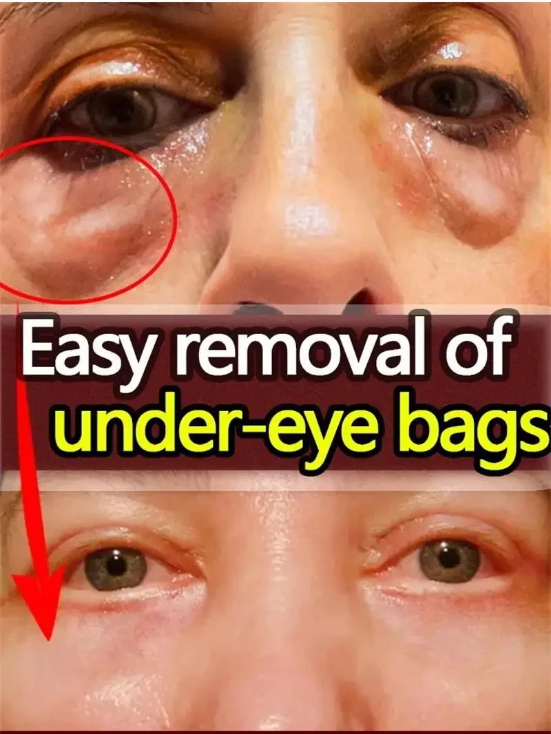 10pcs-1-box-eyes-bag-remove-collagen-eye-patch-instant-fade-fine-lines-dark-circles-fat-particles-moisturizing-anti-puffiness-korea-eye-care_PD5479