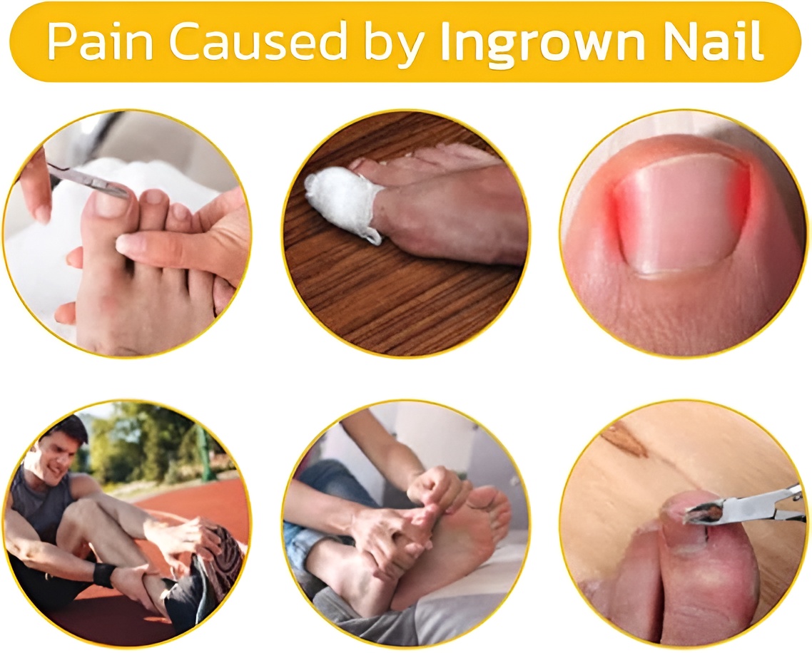 30-pcs---glue-free-ingrow-toenail-corrector-stickers-ingrown-toe-nail-pain-reliever-patches_PD4735