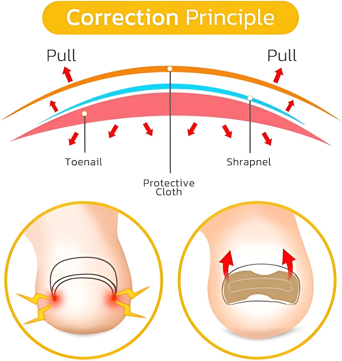 30-pcs---glue-free-ingrow-toenail-corrector-stickers-ingrown-toe-nail-pain-reliever-patches_PD4735