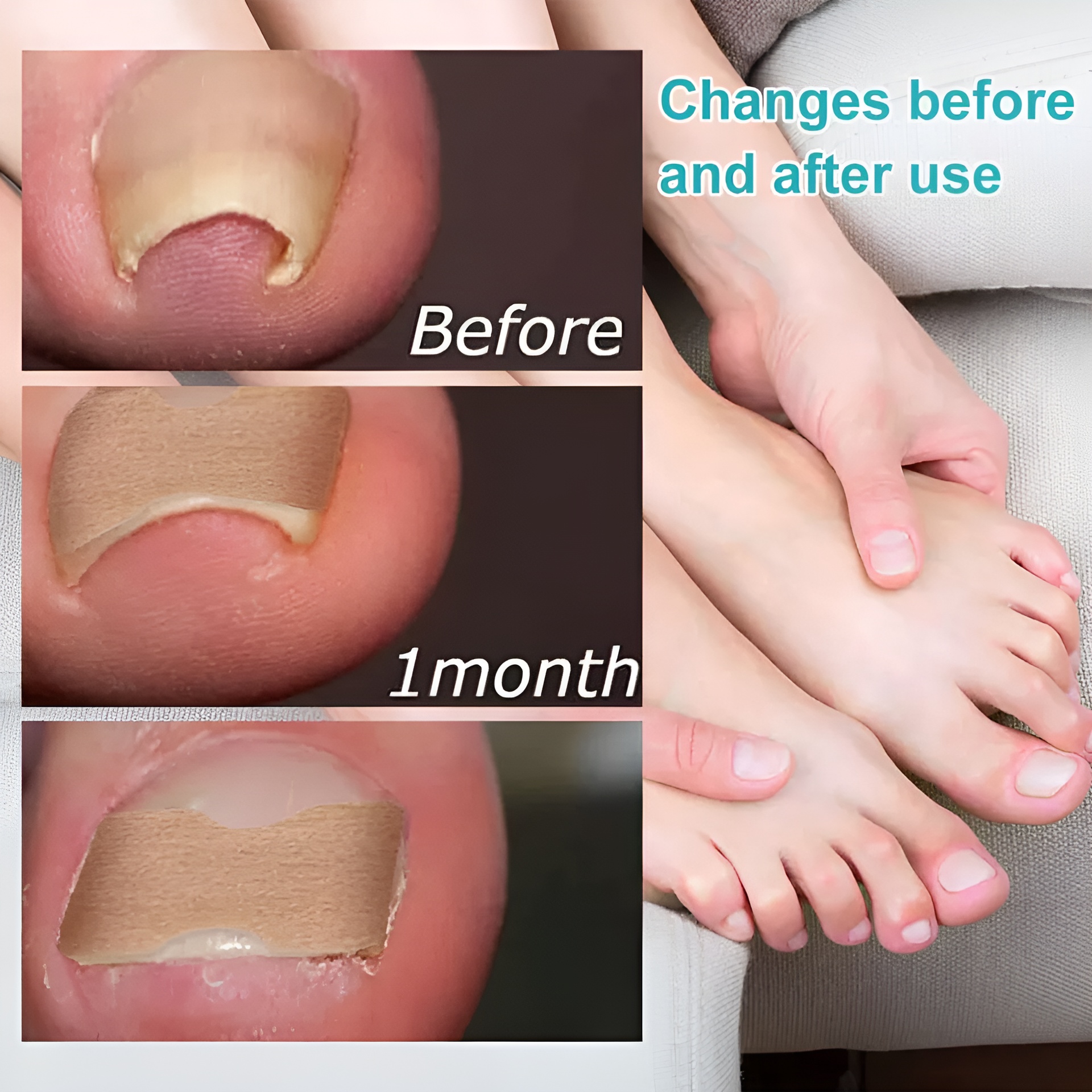 30-pcs---glue-free-ingrow-toenail-corrector-stickers-ingrown-toe-nail-pain-reliever-patches_PD4735