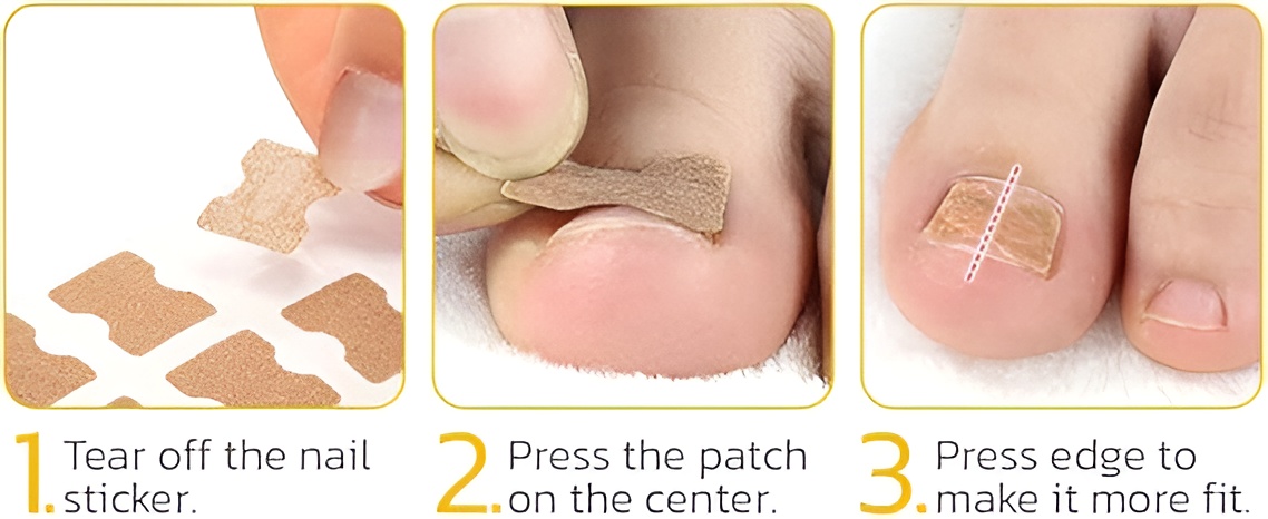 30-pcs---glue-free-ingrow-toenail-corrector-stickers-ingrown-toe-nail-pain-reliever-patches_PD4735