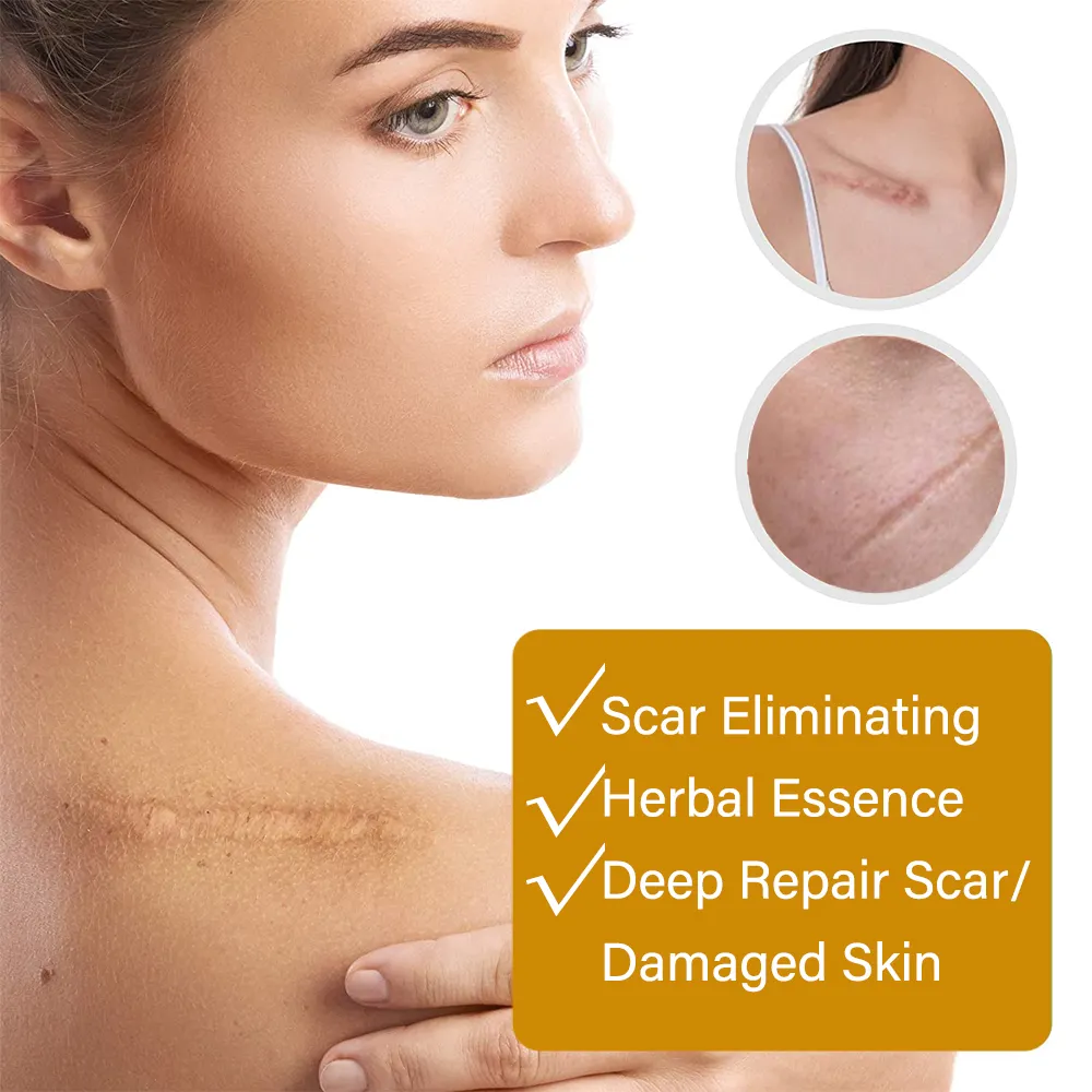 acne-scar-removal-rejuvenation-serum-scar-c-section-amp-stretch-mark-removal-oil-for-women_PD2770