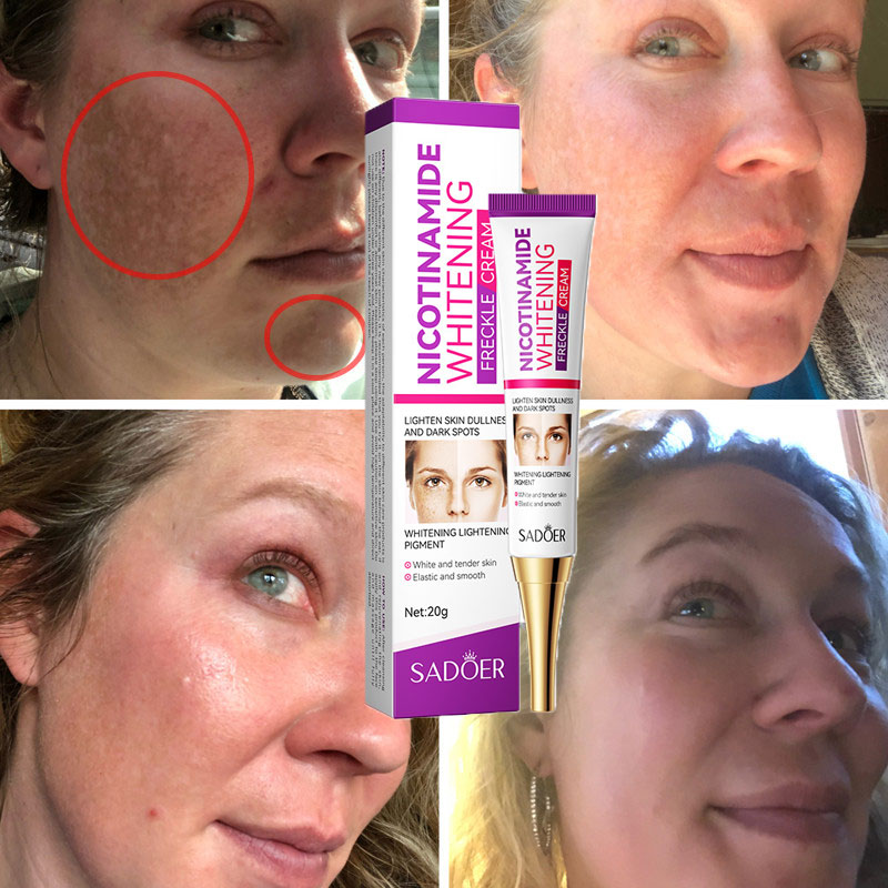 nicotinamide-whitening-freckles-cream-remove-melasma-dark-spot-acne-marks-lightening-melanin-brightens-skin-tone-face-skin-care_PD2656