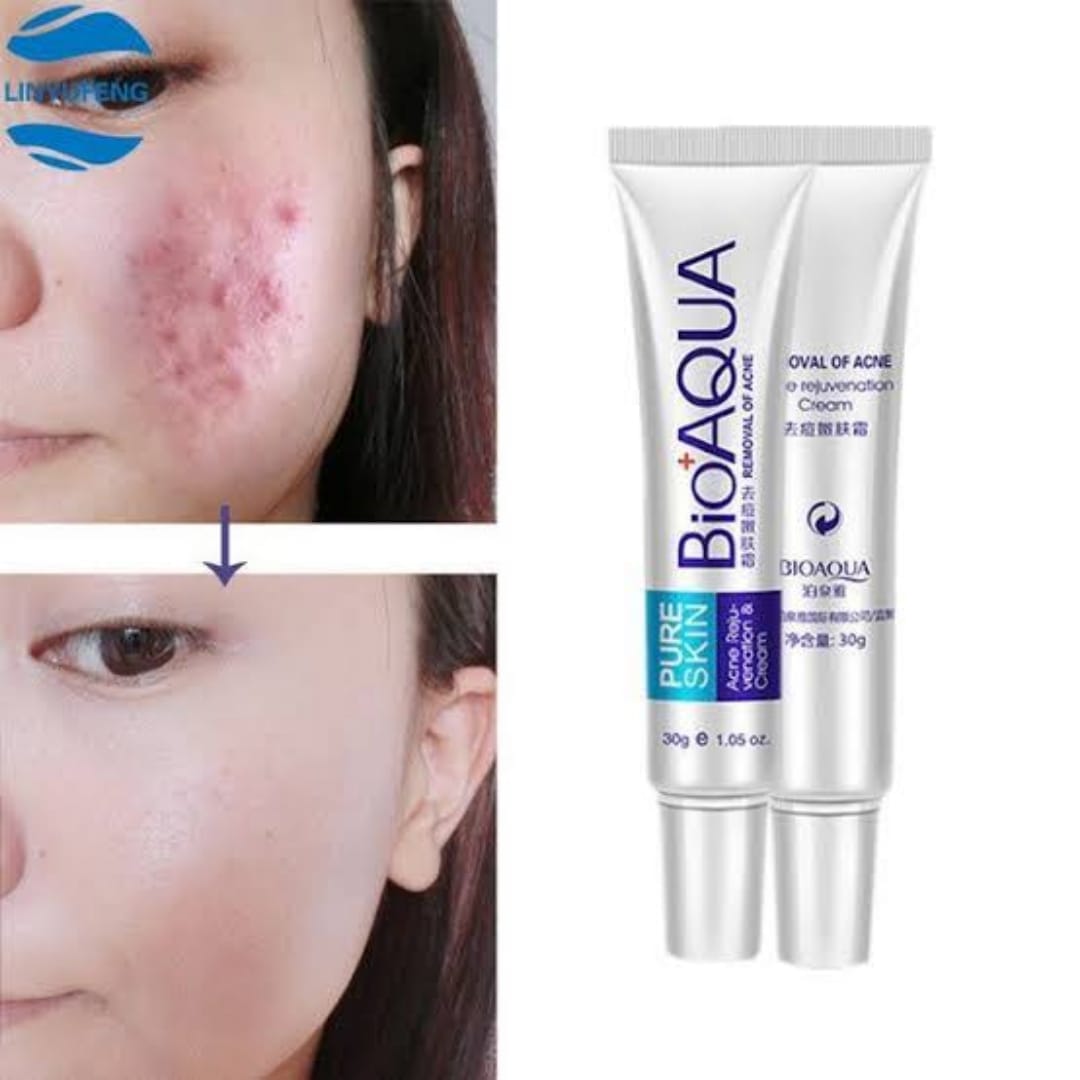 bioaqua-anti-acne-cream-acne-scar-removal-cream-best-quality-scar-removal-cream-original_PD8082