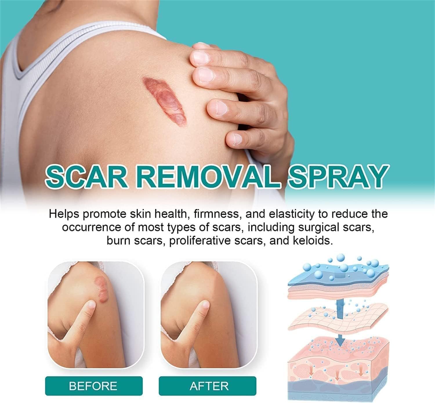 scar-removescar-remove-medical-grade-scar-spraymedical-grade-scar-removal-sprayscar-removal-sprayscar-remove-sprayscar-sprayadvanced-acne-scar-treatment-for-face-1pcs_PD8648