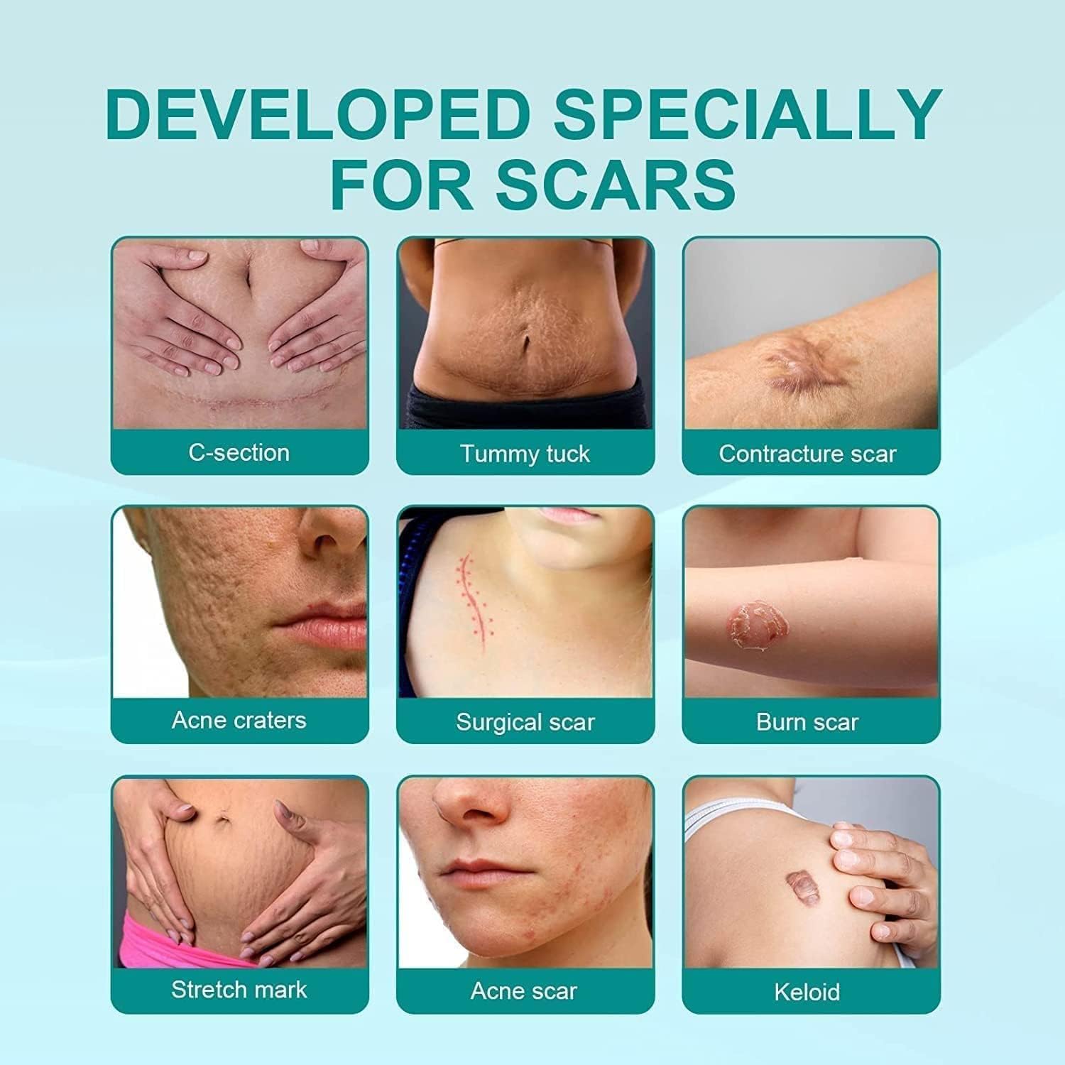 scar-removescar-remove-medical-grade-scar-spraymedical-grade-scar-removal-sprayscar-removal-sprayscar-remove-sprayscar-sprayadvanced-acne-scar-treatment-for-face-1pcs_PD8648